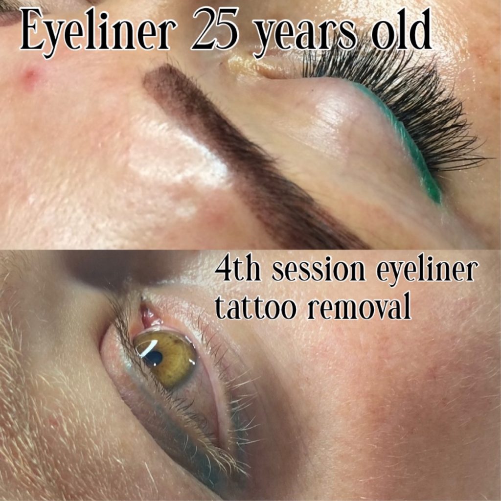 We will be lightening enough to do a coverup/correction. We'll see you... |  saline tattoo removal process | TikTok